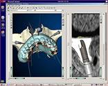 Perfect Smile clinical steps for Nobel Guide